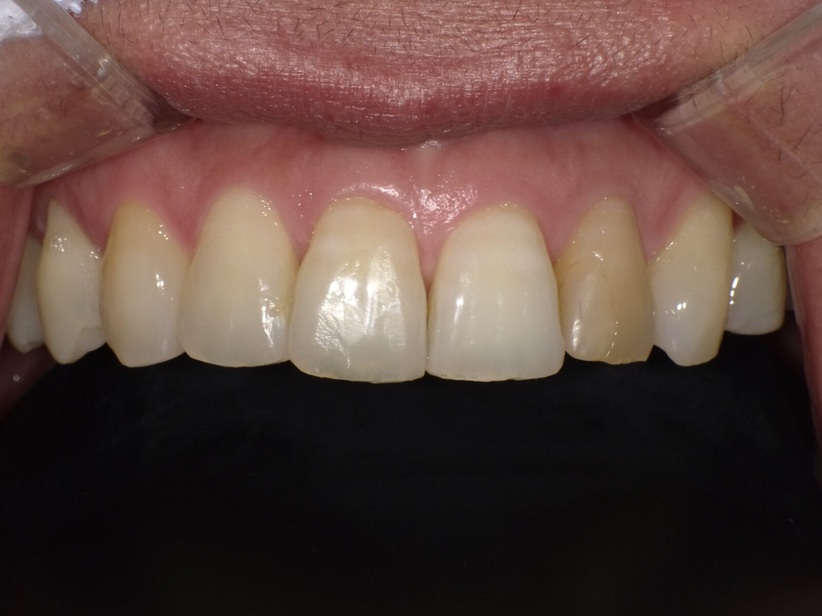 治療前